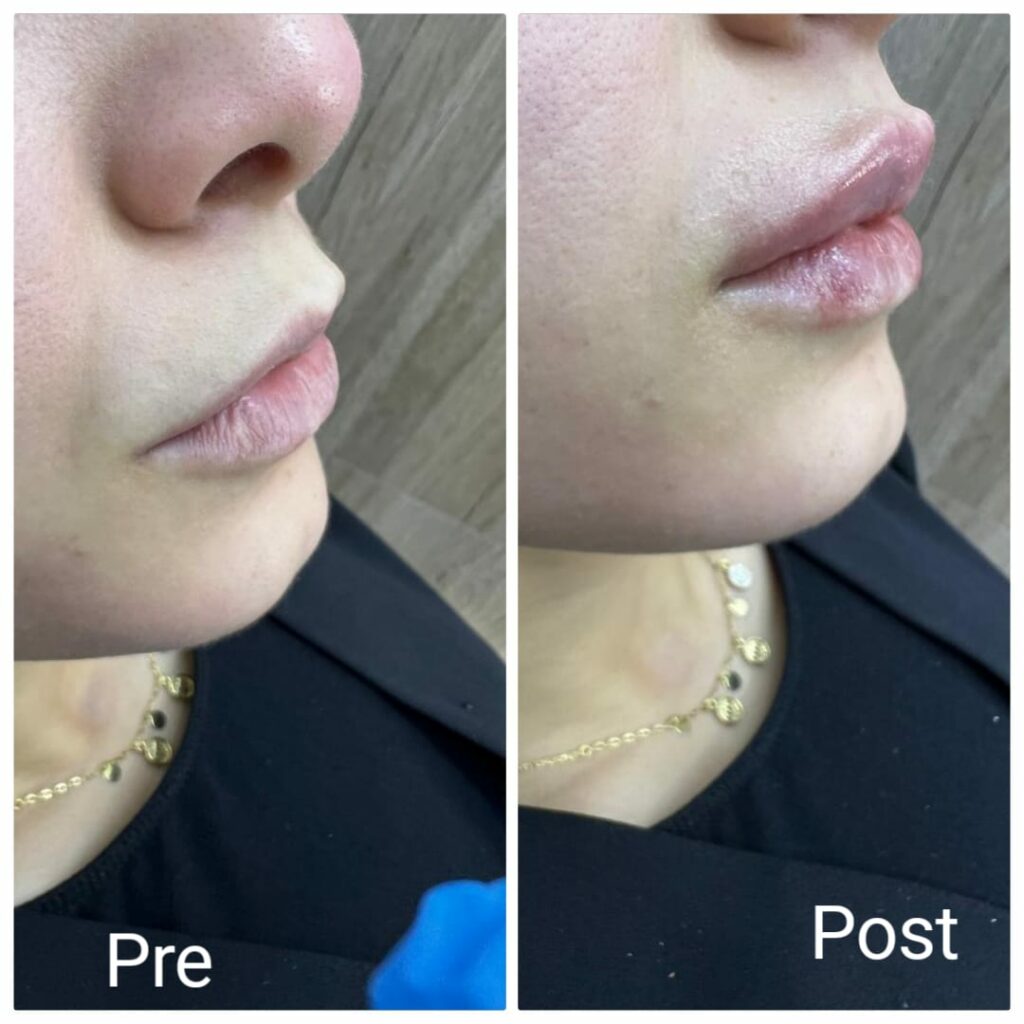Filler injections for lip augmentation